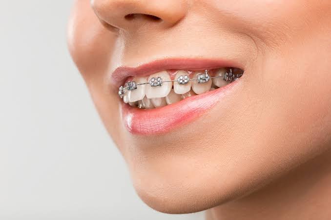 Modern dental braces for teeth straightening